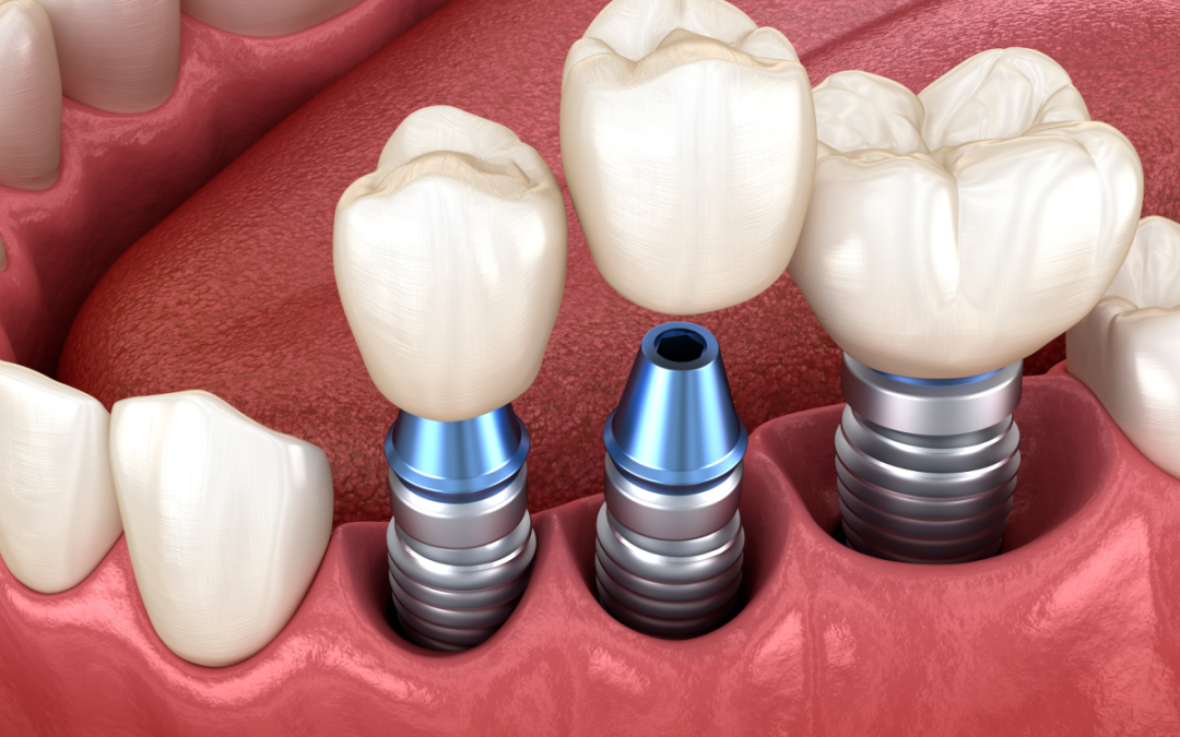 Dental Implants Cost Per Tooth: Factors Affecting Prices